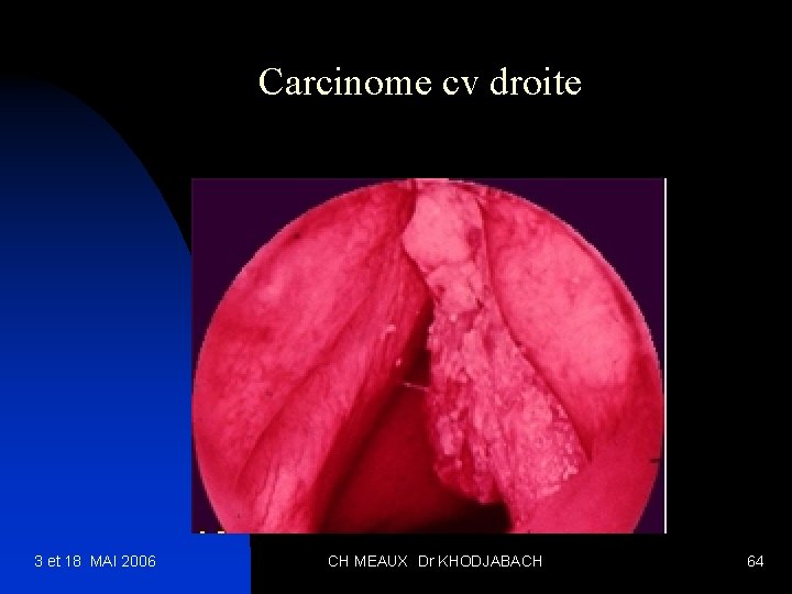 Carcinome cv droite 3 et 18 MAI 2006 CH MEAUX Dr KHODJABACH 64 