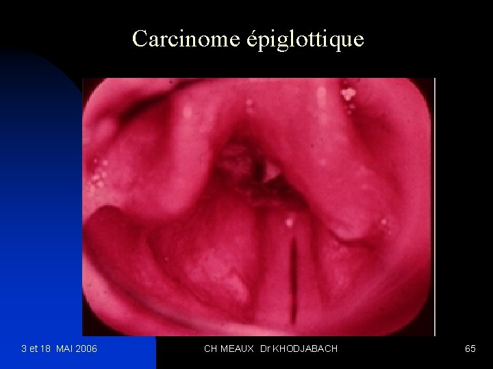 Carcinome épiglottique 3 et 18 MAI 2006 CH MEAUX Dr KHODJABACH 65 