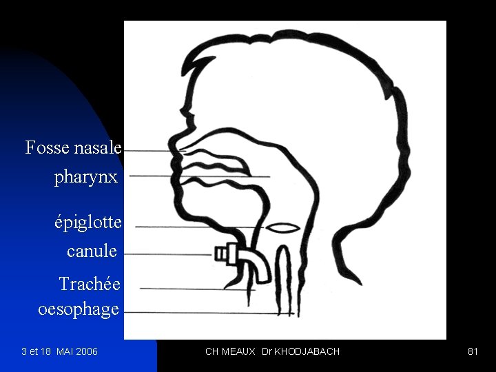 Fosse nasale pharynx épiglotte canule Trachée oesophage 3 et 18 MAI 2006 CH MEAUX