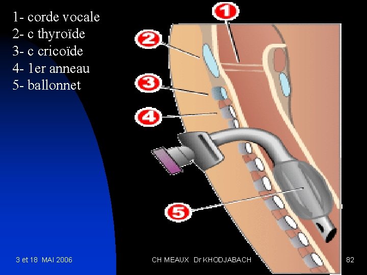 1 - corde vocale 2 - c thyroïde 3 - c cricoïde 4 -