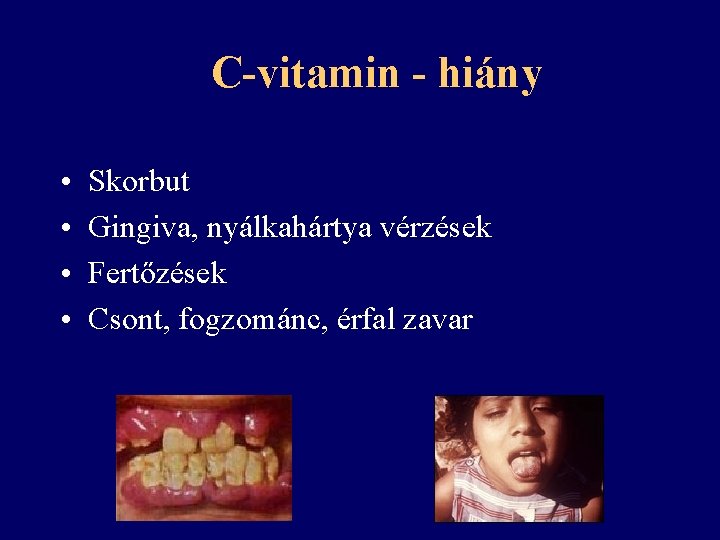 C-vitamin - hiány • • Skorbut Gingiva, nyálkahártya vérzések Fertőzések Csont, fogzománc, érfal zavar