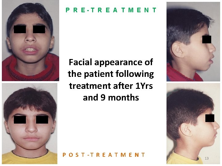 P R E-T R E A T M E N T Facial appearance of