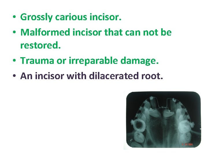  • Grossly carious incisor. • Malformed incisor that can not be restored. •