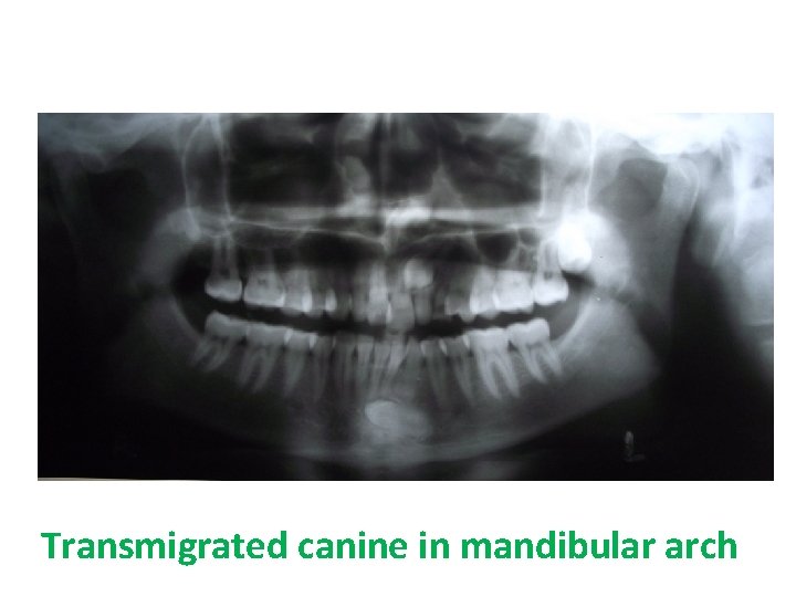 Transmigrated canine in mandibular arch 