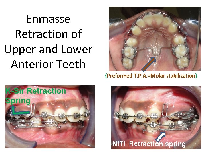 Enmasse Retraction of Upper and Lower Anterior Teeth {Preformed T. P. A. =Molar stabilization}