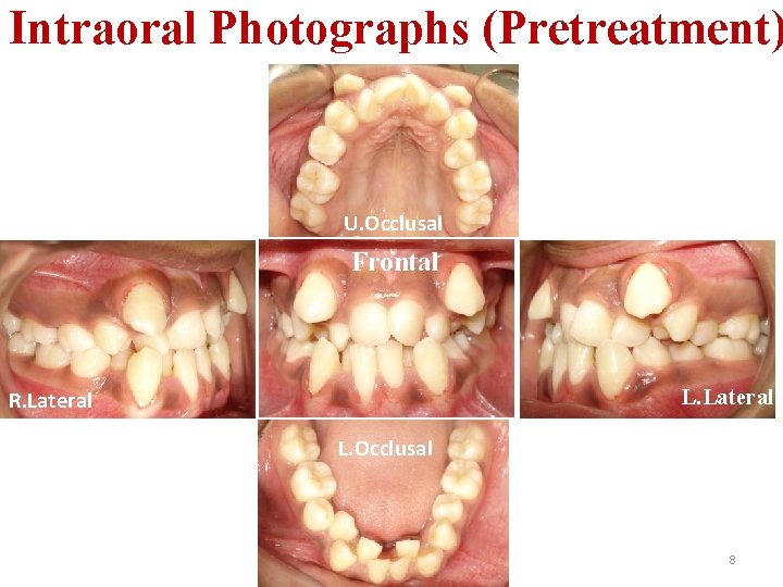 Intraoral Photographs (Pretreatment) U. Occlusal Frontal L. Lateral R. Lateral L. Occlusal 8 
