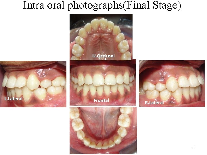 Intra oral photographs(Final Stage) U. Occlusal L. Lateral Frontal R. Lateral 9 