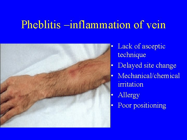 Pheblitis –inflammation of vein • Lack of asceptic technique • Delayed site change •