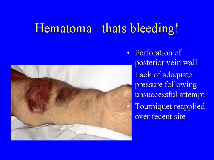 Hematoma –thats bleeding! • Perforation of posterior vein wall • Lack of adequate pressure