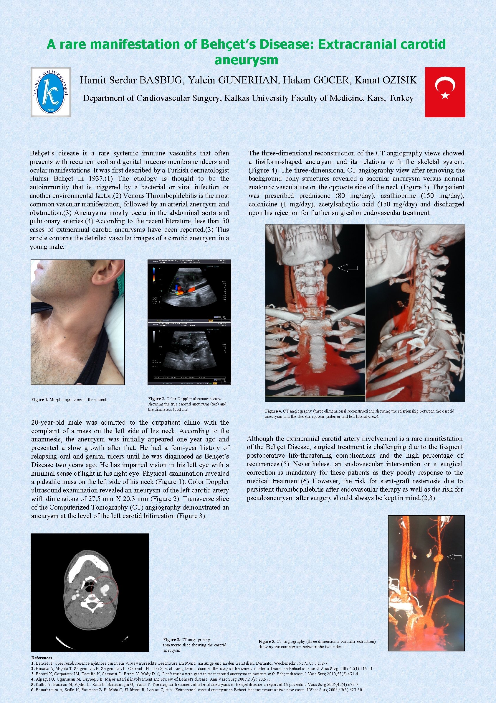 A rare manifestation of Behçet’s Disease: Extracranial carotid aneurysm Hamit Serdar BASBUG, Yalcin GUNERHAN,