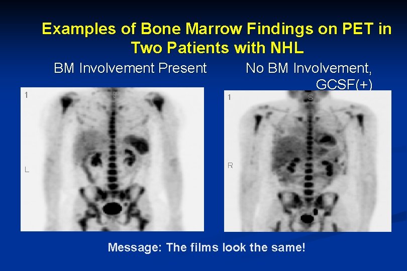 Examples of Bone Marrow Findings on PET in Two Patients with NHL BM Involvement