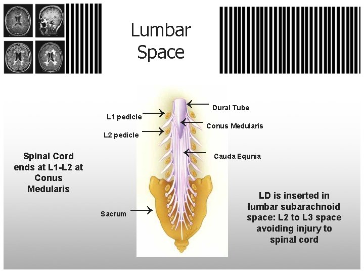 Lumbar Space ← → ← Dural Tube L 1 pedicle Conus Medularis L 2