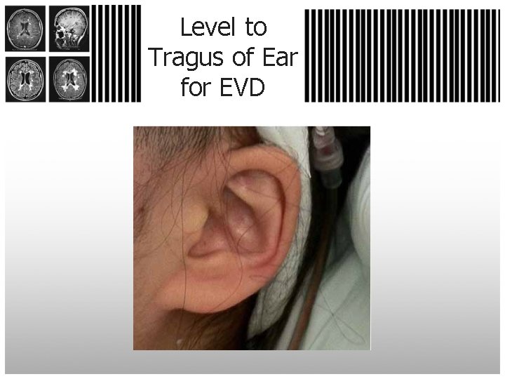 Level to Tragus of Ear for EVD 