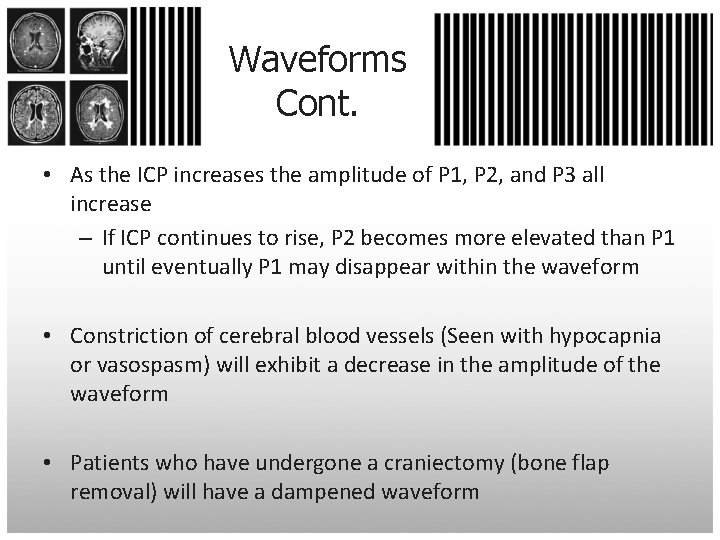 Waveforms Cont. • As the ICP increases the amplitude of P 1, P 2,