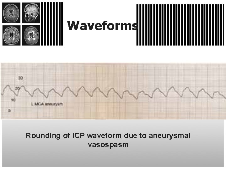 Waveforms Rounding of ICP waveform due to aneurysmal vasospasm 