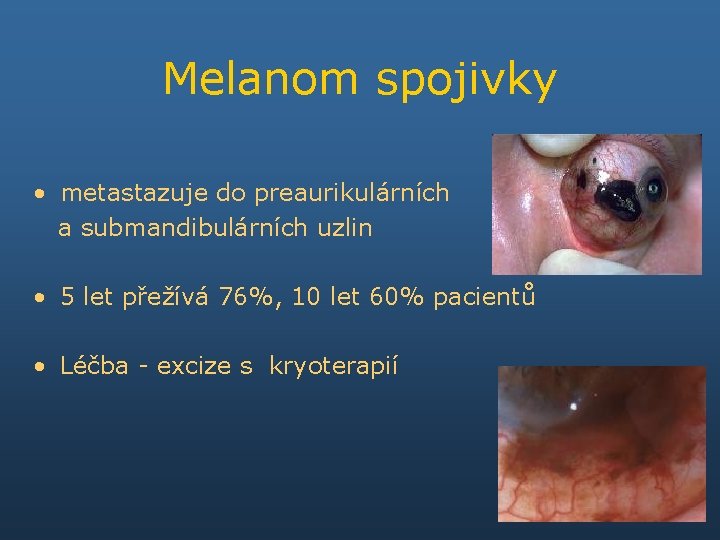 Melanom spojivky • metastazuje do preaurikulárních a submandibulárních uzlin • 5 let přežívá 76%,