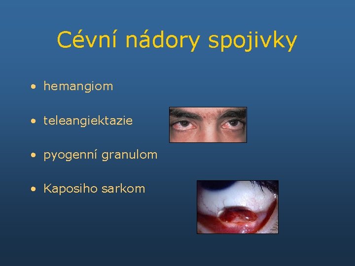 Cévní nádory spojivky • hemangiom • teleangiektazie • pyogenní granulom • Kaposiho sarkom 