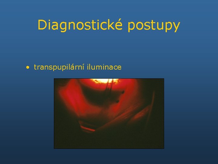 Diagnostické postupy • transpupilární iluminace 