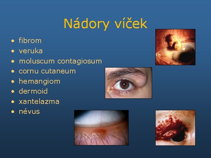 Nádory víček • • fibrom veruka moluscum contagiosum cornu cutaneum hemangiom dermoid xantelazma névus