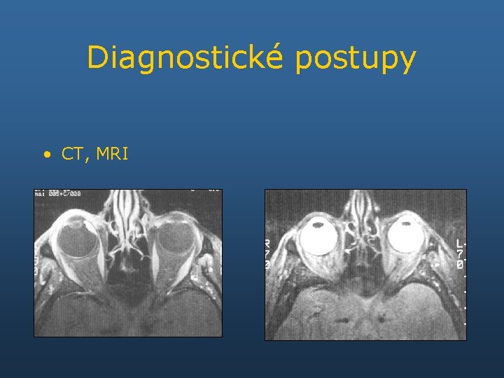 Diagnostické postupy • CT, MRI 