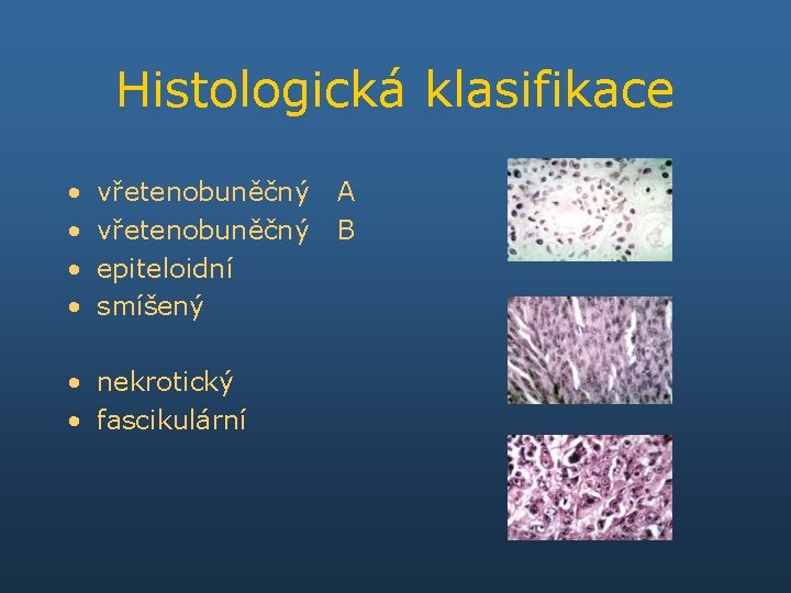 Histologická klasifikace • • vřetenobuněčný epiteloidní smíšený • nekrotický • fascikulární A B 