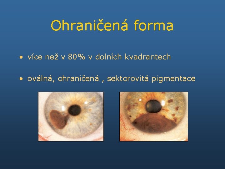 Ohraničená forma • více než v 80% v dolních kvadrantech • oválná, ohraničená ,