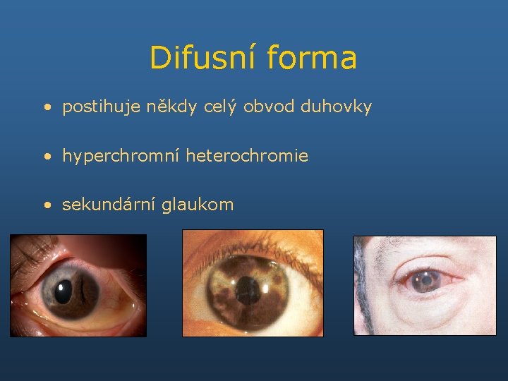 Difusní forma • postihuje někdy celý obvod duhovky • hyperchromní heterochromie • sekundární glaukom