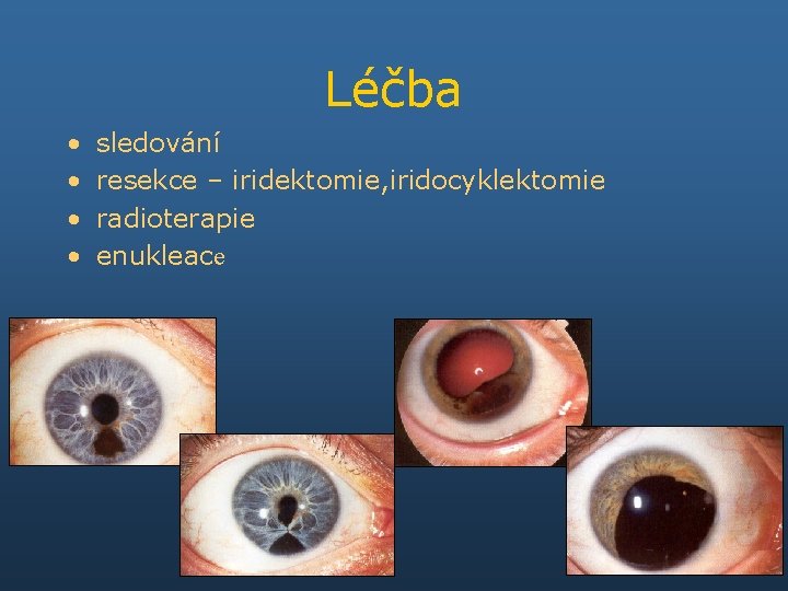 Léčba • • sledování resekce – iridektomie, iridocyklektomie radioterapie enukleace 