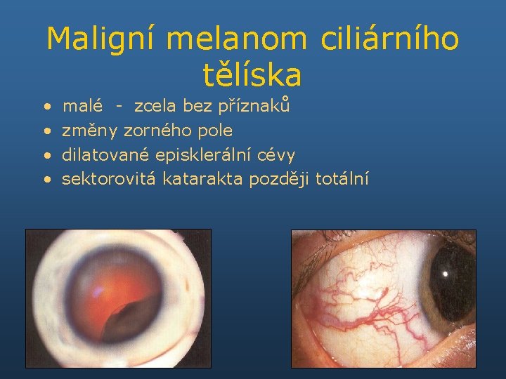 Maligní melanom ciliárního tělíska • • malé - zcela bez příznaků změny zorného pole