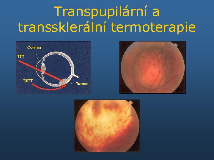 Transpupilární a transsklerální termoterapie 