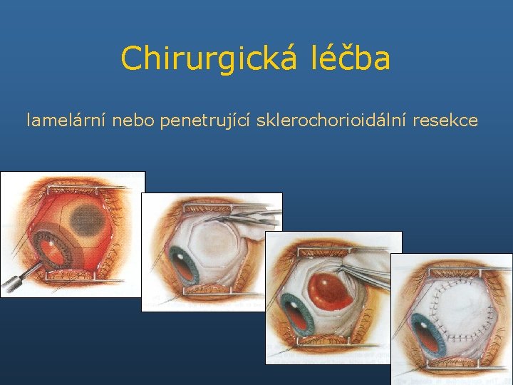 Chirurgická léčba lamelární nebo penetrující sklerochorioidální resekce 