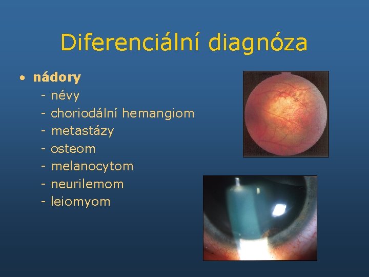 Diferenciální diagnóza • nádory - névy - choriodální hemangiom - metastázy - osteom -