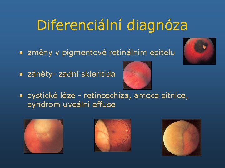 Diferenciální diagnóza • změny v pigmentové retinálním epitelu • záněty- zadní skleritida • cystické