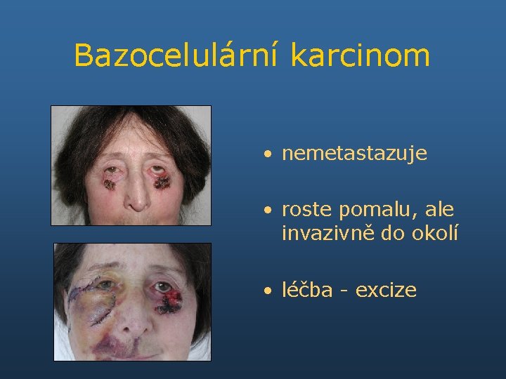 Bazocelulární karcinom • nemetastazuje • roste pomalu, ale invazivně do okolí • léčba -