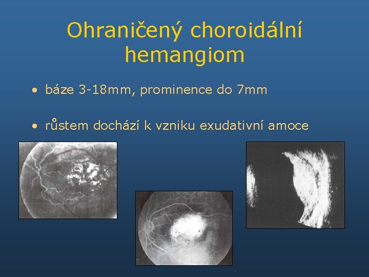 Ohraničený choroidální hemangiom • báze 3 -18 mm, prominence do 7 mm • růstem