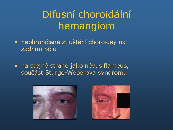 Difusní choroidální hemangiom • neohraničené ztluštění choroidey na zadním pólu • na stejné straně