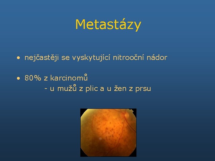 Metastázy • nejčastěji se vyskytující nitrooční nádor • 80% z karcinomů - u mužů