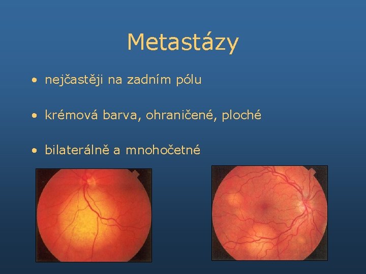 Metastázy • nejčastěji na zadním pólu • krémová barva, ohraničené, ploché • bilaterálně a