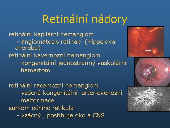 Retinální nádory retinální kapilární hemangiom - angiomatosis retinae (Hippelova choroba) retinální kavernozní hemangiom -