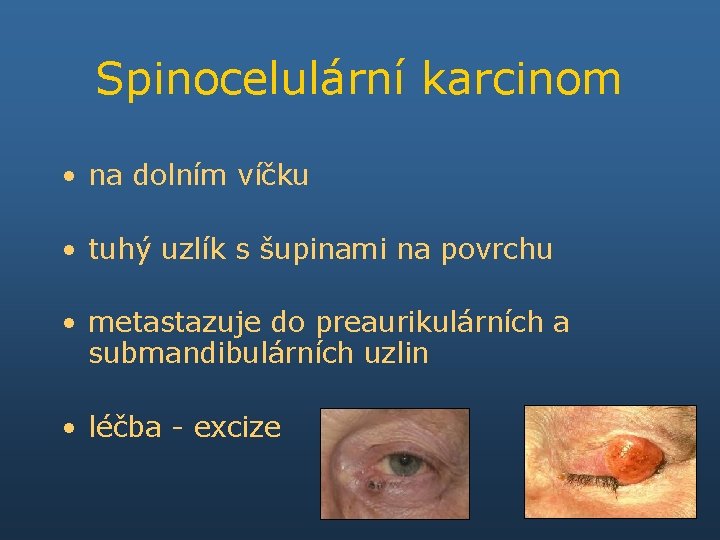 Spinocelulární karcinom • na dolním víčku • tuhý uzlík s šupinami na povrchu •