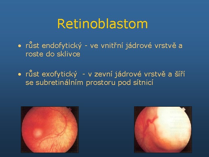 Retinoblastom • růst endofytický - ve vnitřní jádrové vrstvě a roste do sklivce •