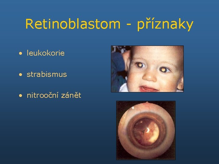 Retinoblastom - příznaky • leukokorie • strabismus • nitrooční zánět 