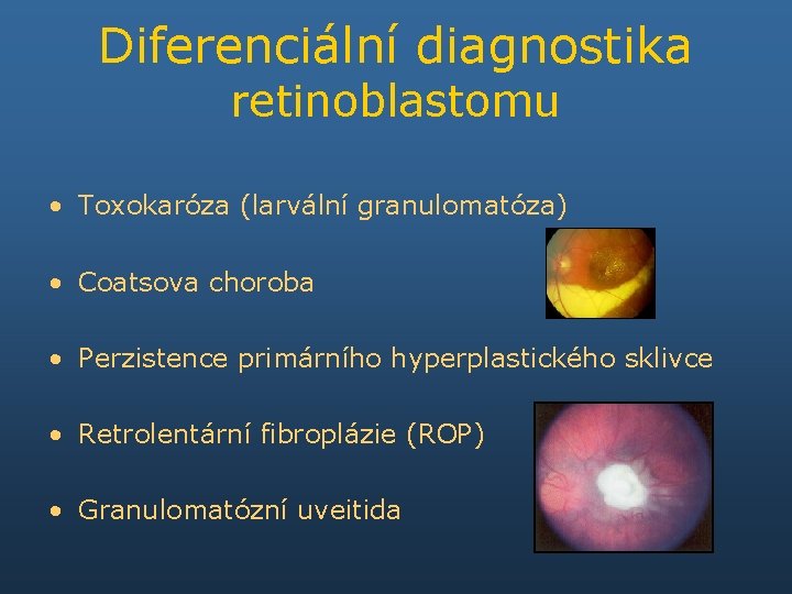 Diferenciální diagnostika retinoblastomu • Toxokaróza (larvální granulomatóza) • Coatsova choroba • Perzistence primárního hyperplastického