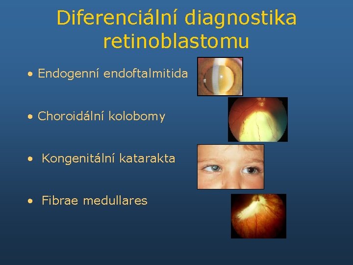 Diferenciální diagnostika retinoblastomu • Endogenní endoftalmitida • Choroidální kolobomy • Kongenitální katarakta • Fibrae
