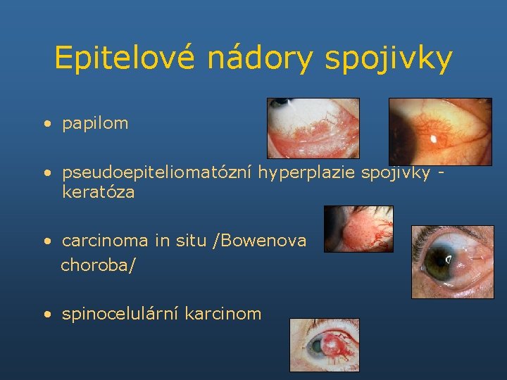 Epitelové nádory spojivky • papilom • pseudoepiteliomatózní hyperplazie spojivky keratóza • carcinoma in situ