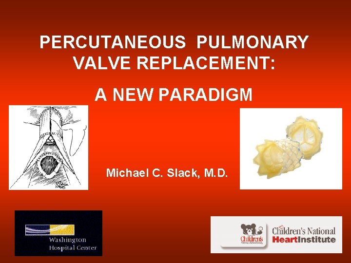 PERCUTANEOUS PULMONARY VALVE REPLACEMENT: A NEW PARADIGM Michael C. Slack, M. D. 