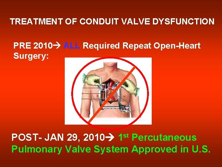 TREATMENT OF CONDUIT VALVE DYSFUNCTION PRE 2010 ALL Required Repeat Open-Heart Surgery: POST- JAN