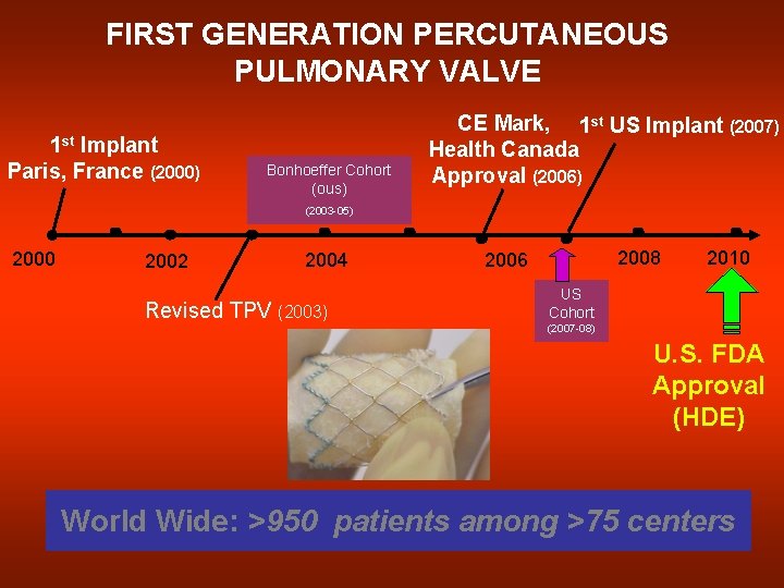 FIRST GENERATION PERCUTANEOUS PULMONARY VALVE 1 st Implant Paris, France (2000) Bonhoeffer Cohort (ous)