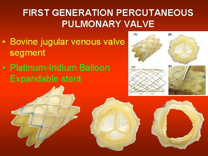 FIRST GENERATION PERCUTANEOUS PULMONARY VALVE • Bovine jugular venous valve segment • Platinum-Iridium Balloon