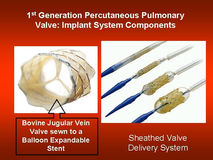 1 st Generation Percutaneous Pulmonary Valve: Implant System Components Bovine Jugular Vein Valve sewn